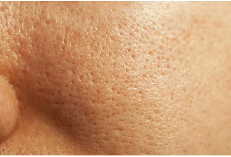 What are the best ways to get rid of large pores?