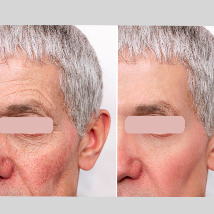 Woodbine Cosmetic Clinic Botox Injection