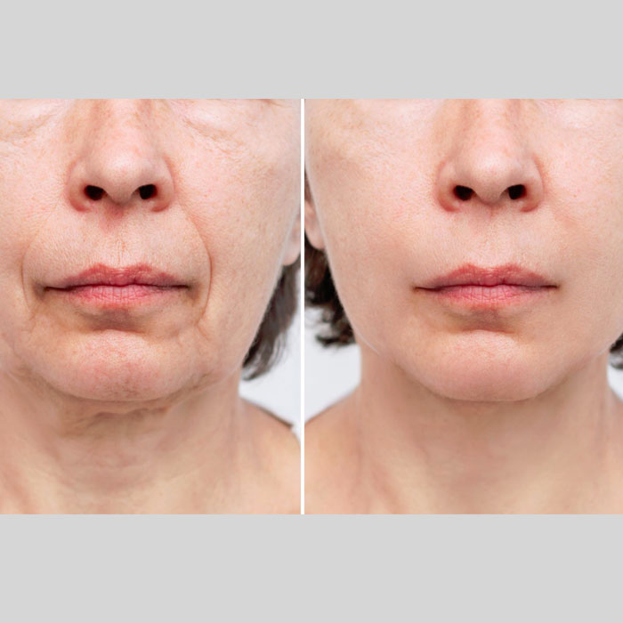 Woodbine Cosmetic Clinic Botox Injection