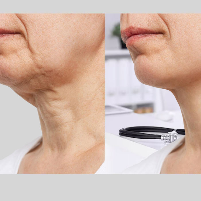 filler injection toronto