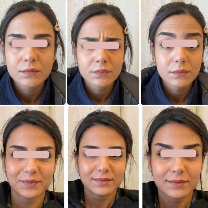 filler injection toronto