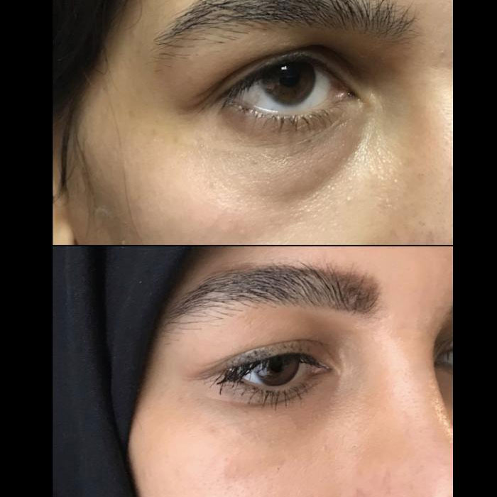 Woodbine Cosmetic Clinic Botox Injection