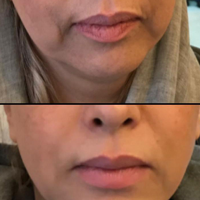 Woodbine Cosmetic Clinic Botox Injection