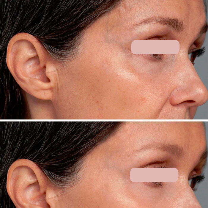 Woodbine Cosmetics Clinic Botox® Injections