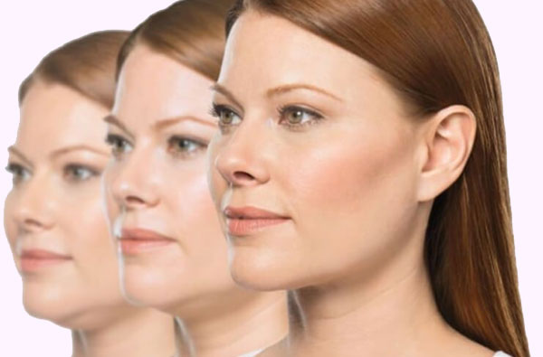 Belkyra Chin Treatment