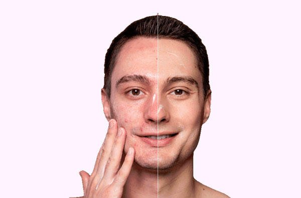 Belkyra Chin Treatment