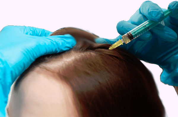 PRP Hair Restoration