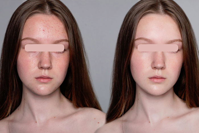 Double Chin Removal Treatment 