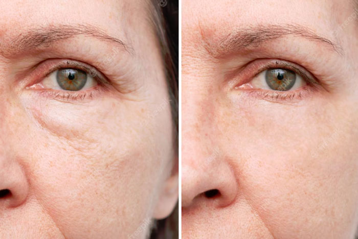 Double Chin Removal Treatment 