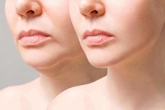 Double Chin Removal Treatment 