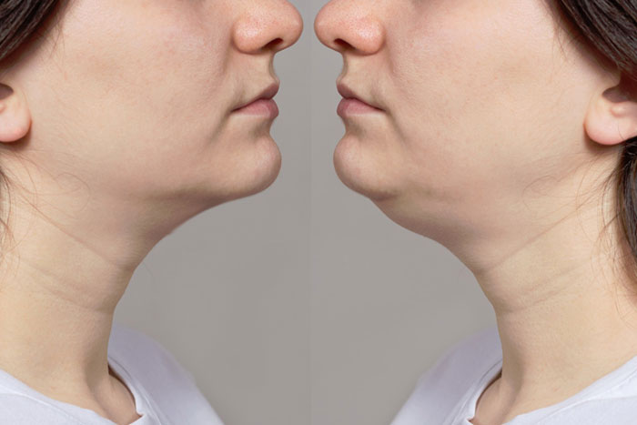 Double Chin Removal Treatment 