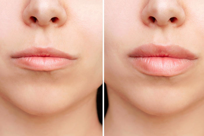 Lip Fillers & Injections Toronto
