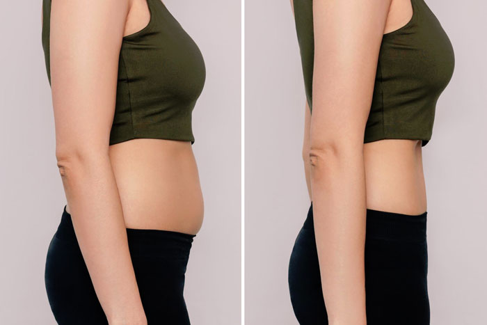 Body Fat Reduction With Lipolysis Injections
