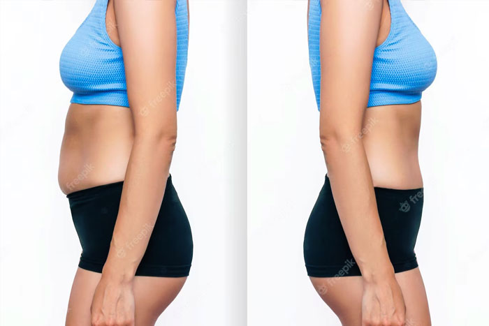 Body Fat Reduction With Lipolysis Injections