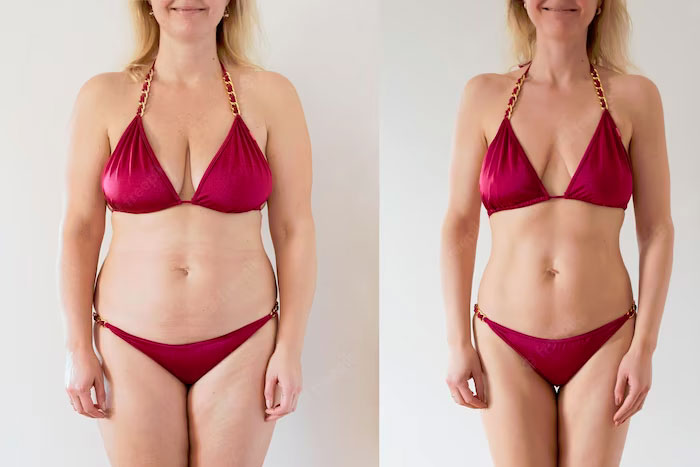 Body Fat Reduction With Lipolysis Injections